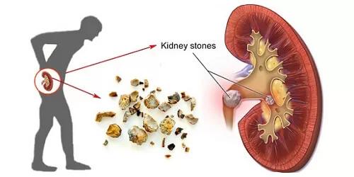 obat batu ginjal