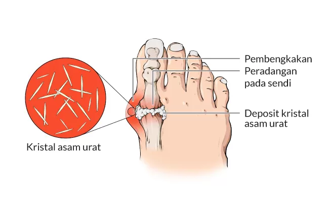 Gambar Kristal Asam Urat