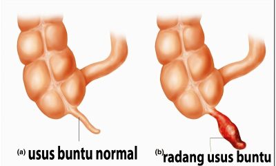 Obat Alami Usus Buntu