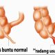 Obat Alami Usus Buntu